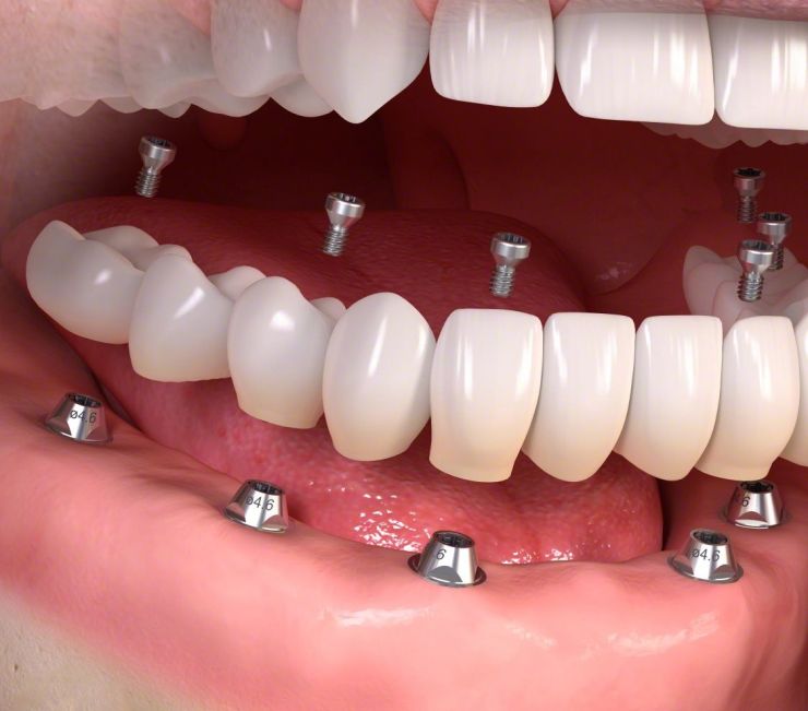 zahn implantate
