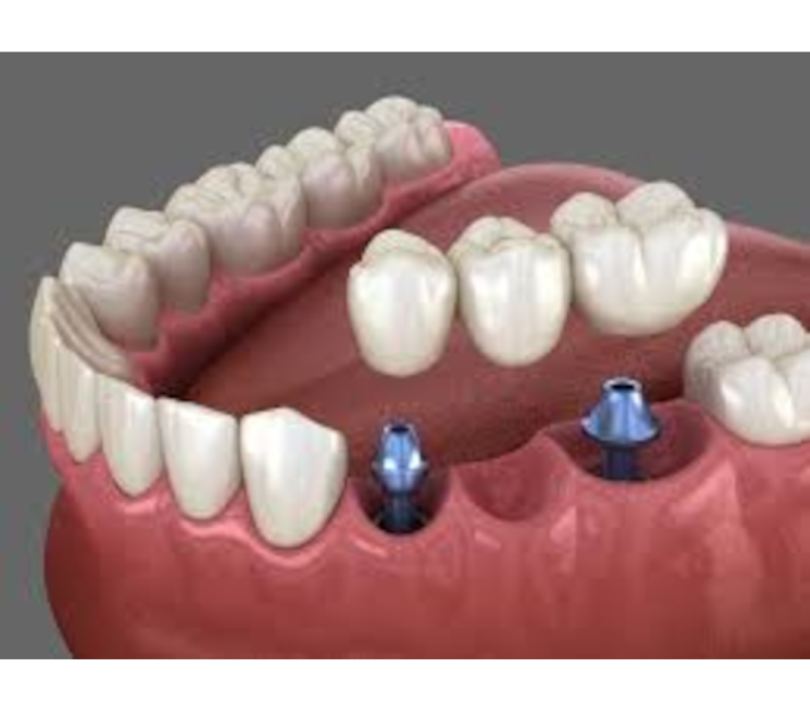 zahn implantate