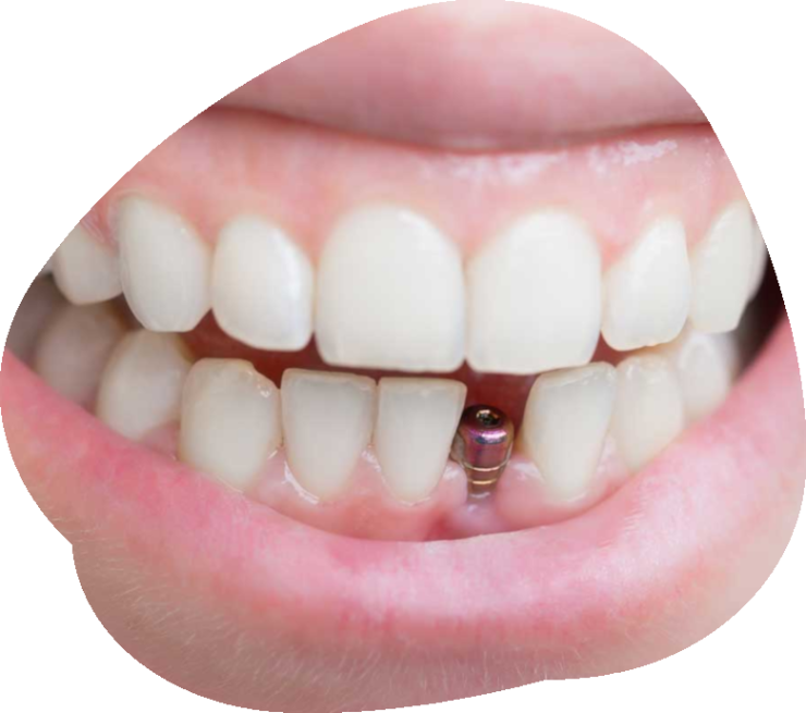 zahn implantat